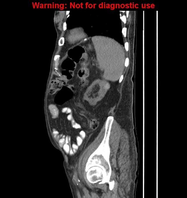 Aortic graft infection (Radiopaedia 44979-48907 C 17).jpg
