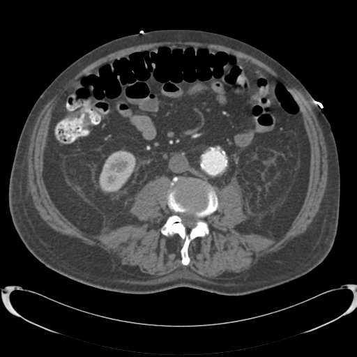 Aortic intramural hematoma (Radiopaedia 34260-35540 B 61).png