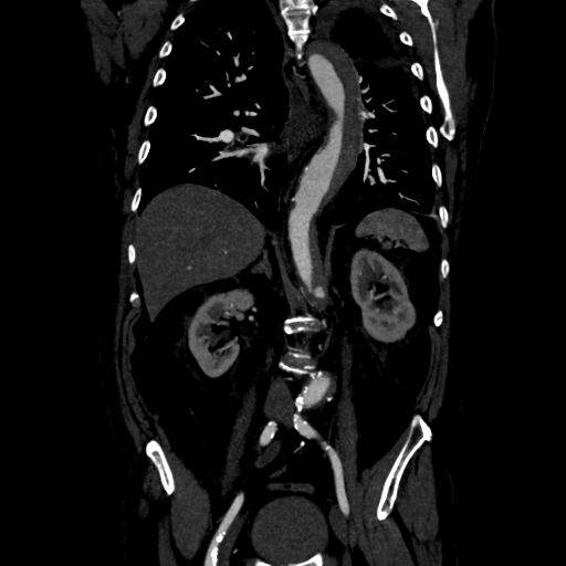 Aortic intramural hematoma (Radiopaedia 34260-35540 C 55).png
