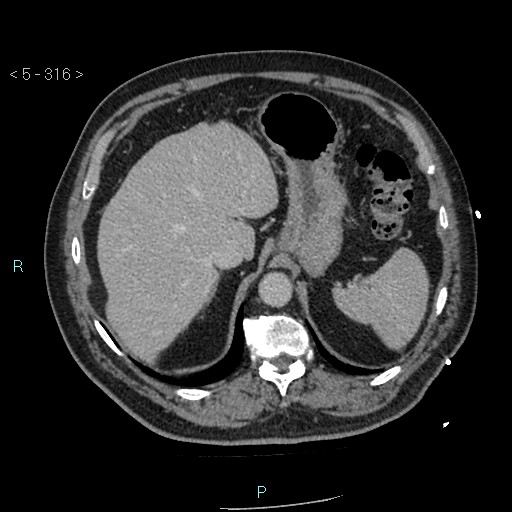 Aortic intramural hematoma (Radiopaedia 48463-53380 C 142).jpg