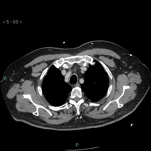 Aortic intramural hematoma (Radiopaedia 48463-53380 C 32).jpg