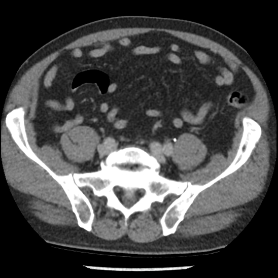 File:Aortic intramural hematoma (type B) (Radiopaedia 79323-92387 Axial C+ delayed 91).jpg