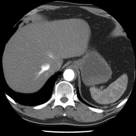 Aortic intramural hematoma (type B) (Radiopaedia 79323-92387 B 49).jpg