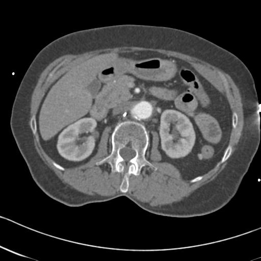 Aortic intramural hematoma from penetrating atherosclerotic ulcer (Radiopaedia 31137-31836 A 98).jpg