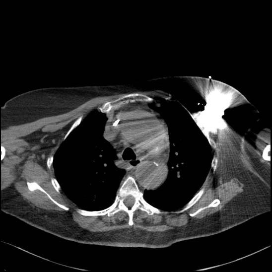 Aortic intramural hematoma with dissection and intramural blood pool (Radiopaedia 77373-89491 Axial non-contrast 31).jpg