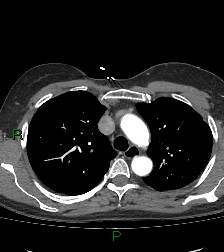 Aortic valve endocarditis (Radiopaedia 87209-103485 C 28).jpg