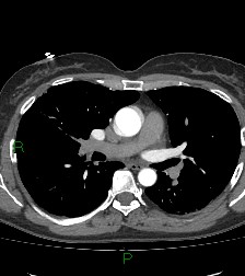 Aortic valve endocarditis (Radiopaedia 87209-103485 C 44).jpg