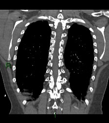 Aortic valve endocarditis (Radiopaedia 87209-103485 D 16).jpg