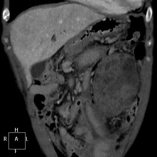 File:Aorto-left renal vein fistula (Radiopaedia 45534-49628 B 4).jpg