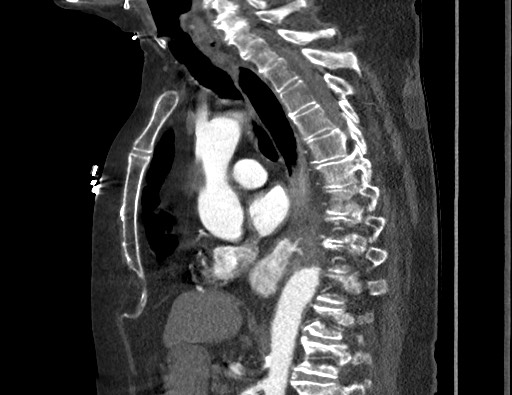 File:Aortoesophageal fistula with endovascular repair (Radiopaedia 73781-84592 Sagittal C+ CTPA 102).jpg