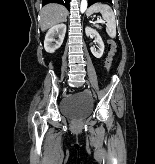 Aortoiliac occlusive disease (Radiopaedia 52352-58248 B 44).jpg