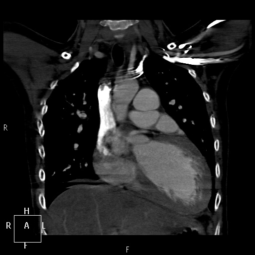 File:Aortopulmonary septal defect (Radiopaedia 41990-45013 Coronal C+ CTPA 22).jpg