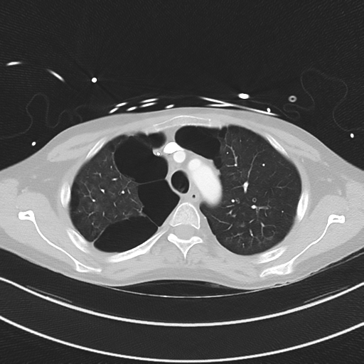 Apical bullous disease in a heavy smoker (Radiopaedia 33067-34092 Axial lung window 17).png