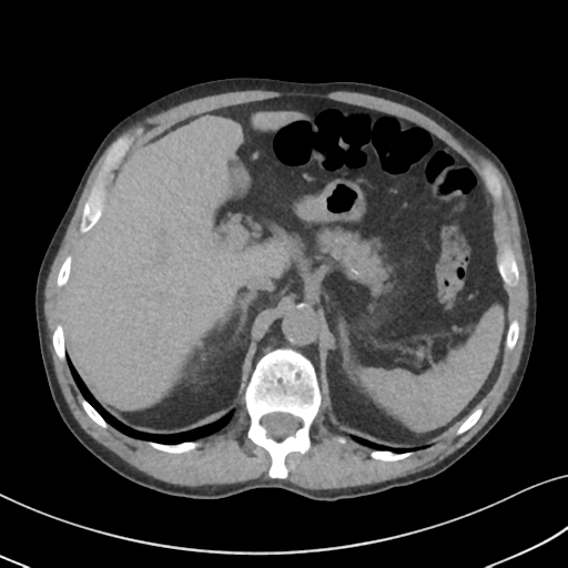 Apical pulmonary metastasis (Radiopaedia 46338-50754 B 62).png