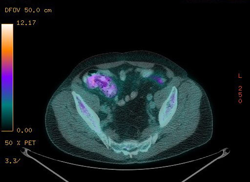 Appendiceal adenocarcinoma complicated by retroperitoneal abscess (Radiopaedia 58007-65041 Axial PET-CT 171).jpg