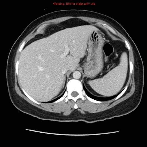 File:Appendiceal mucinous cystadenoma (Radiopaedia 8263-9111 Axial liver window 21).jpg