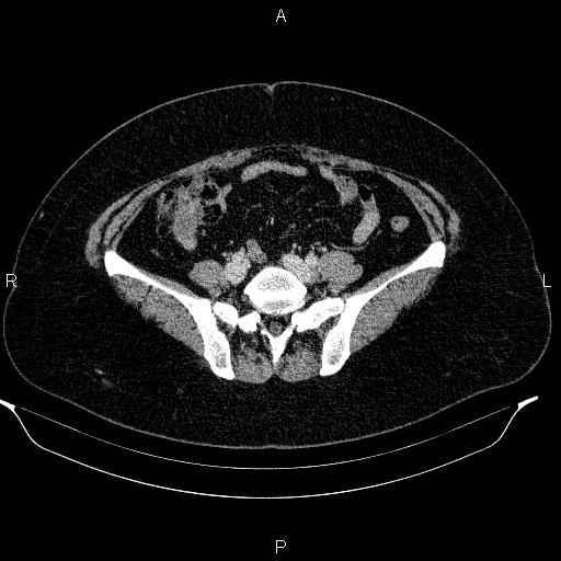 Appendiceal mucocele (Radiopaedia 83280-97688 Axial With contrast 75).jpg