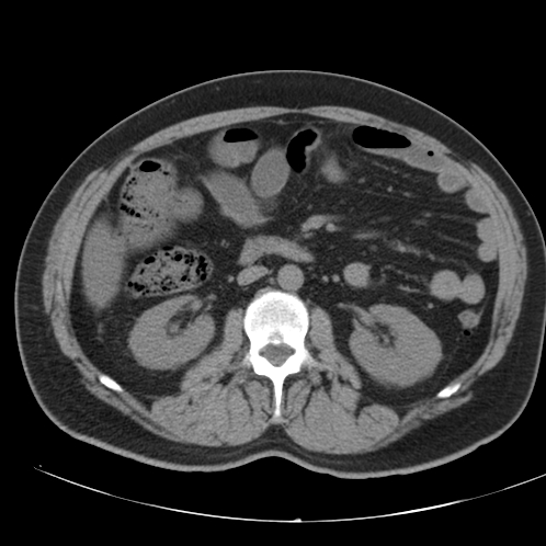 Appendicitis and giant appendicolith (Radiopaedia 80251-93588 Axial non-contrast 24).jpg