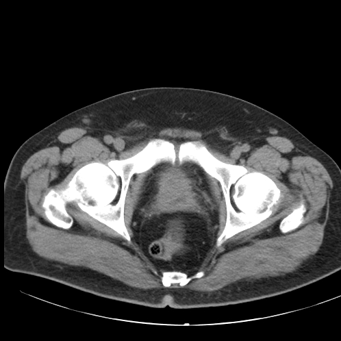 Appendicitis and giant appendicolith (Radiopaedia 80251-93588 Axial non-contrast 56).jpg