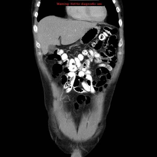 File:Appendicitis and renal cell carcinoma (Radiopaedia 17063-16760 B 7).jpg