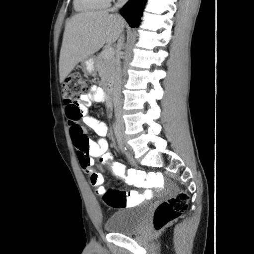 Appendicitis complicated by post-operative collection (Radiopaedia 35595-37114 C 35).jpg