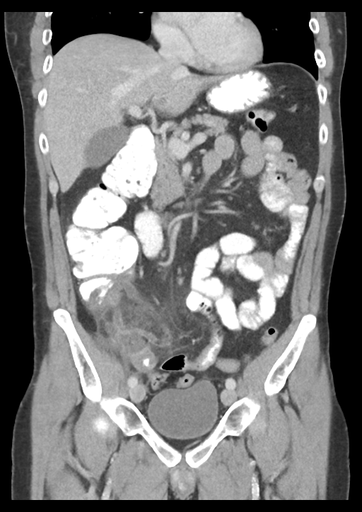 Appendicitis with thickening of the terminal ileum (Radiopaedia 42432-45550 B 25).png