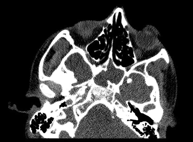 Arachnoid cyst- extremely large (Radiopaedia 68741-78450 Axial bone window 7).jpg
