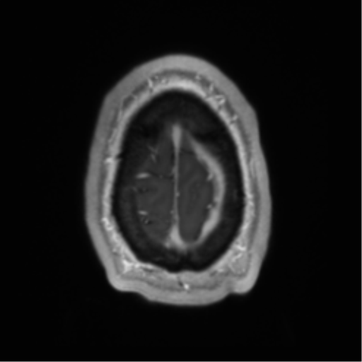 File:Arachnoid cyst with subdural hematoma (Radiopaedia 85892-101743 Axial T1 C+ 77).png