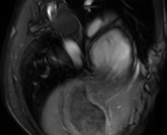 Arrhythmogenic right ventricular cardiomyopathy (Radiopaedia 69564-79464 4ch cine 144).jpg