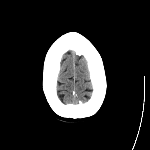 File:Arteriovenous malformation (cerebral) (Radiopaedia 40070-42579 Axial non-contrast 29).png