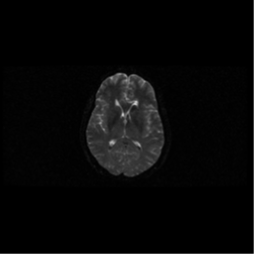 File:Arteriovenous malformation (cerebral) (Radiopaedia 40070-42580 Axial DWI 34).png