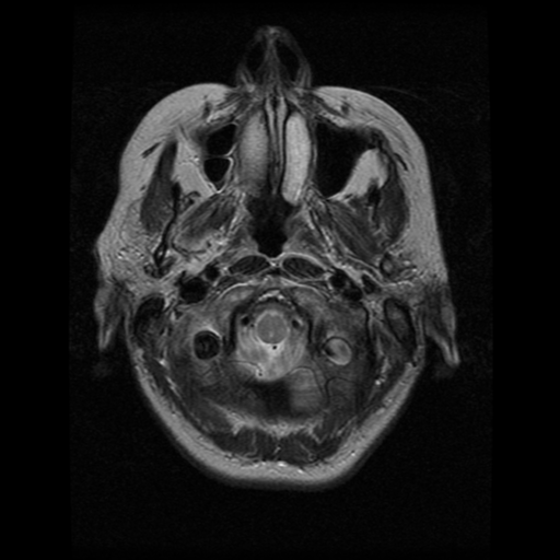 File:Arteriovenous malformation (cerebral) (Radiopaedia 40070-42580 Axial T2 3).png