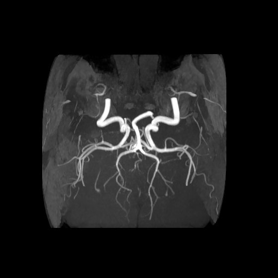 Artery of Percheron infarct (Radiopaedia 40966-43676 F 49).jpg
