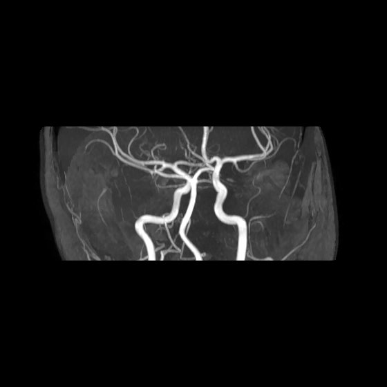 File:Artery of Percheron infarct (Radiopaedia 40966-43676 G 25).jpg