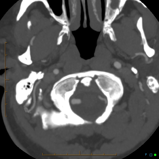 File:Artifactual basilar artery stenosis due to metallic stent (Radiopaedia 31206-31923 A 2).jpg