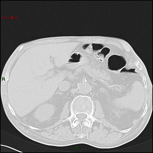 File:Aspergilloma (Radiopaedia 14842-14787 Axial lung window 46).jpg
