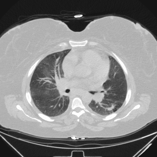 Aspergilloma (Radiopaedia 39611-41932 Axial lung window 61).jpg