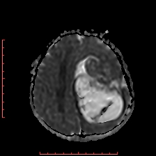File:Astroblastoma (Radiopaedia 74287-85162 Axial ADC 49).jpg