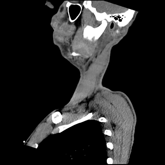 File:Atlanto-occipital dissociation (Traynelis type 1), C2 teardrop fracture, C6-7 facet joint dislocation (Radiopaedia 87655-104061 D 16).jpg