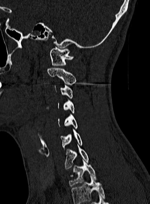 Atlantoaxial subluxation (Radiopaedia 44681-48450 Sagittal bone window 125).jpg