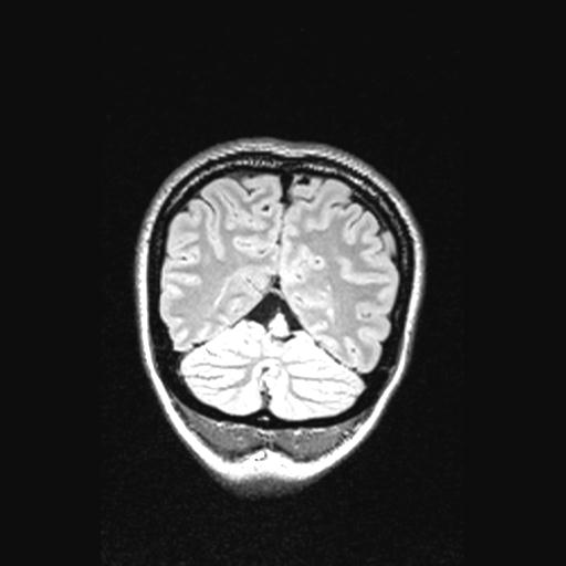 File:Atretic encephalocoele with inferior vermis hypoplasia (Radiopaedia 30443-31108 Coronal FLAIR 40).jpg
