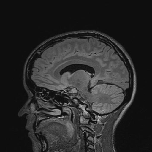 Atretic encephalocoele with inferior vermis hypoplasia (Radiopaedia 30443-31108 Sagittal FLAIR 72).jpg