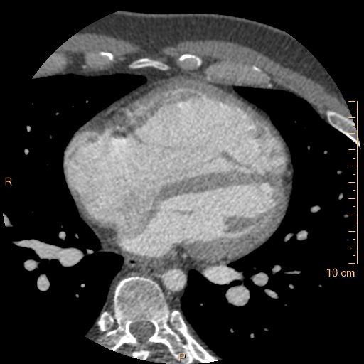 Atrial septal defect (upper sinus venosus type) with partial anomalous pulmonary venous return into superior vena cava (Radiopaedia 73228-83961 A 159).jpg