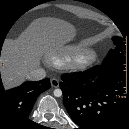 Atrial septal defect (upper sinus venosus type) with partial anomalous pulmonary venous return into superior vena cava (Radiopaedia 73228-83961 A 245).jpg