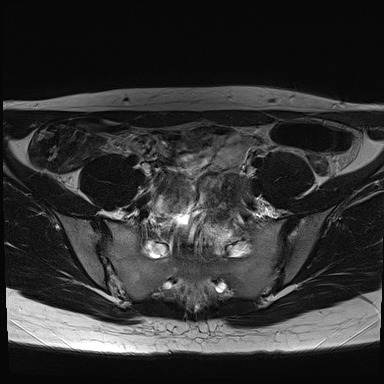File:Atypical deep infiltrating endometriosis (Radiopaedia 44470-48125 Axial T2 4).jpg