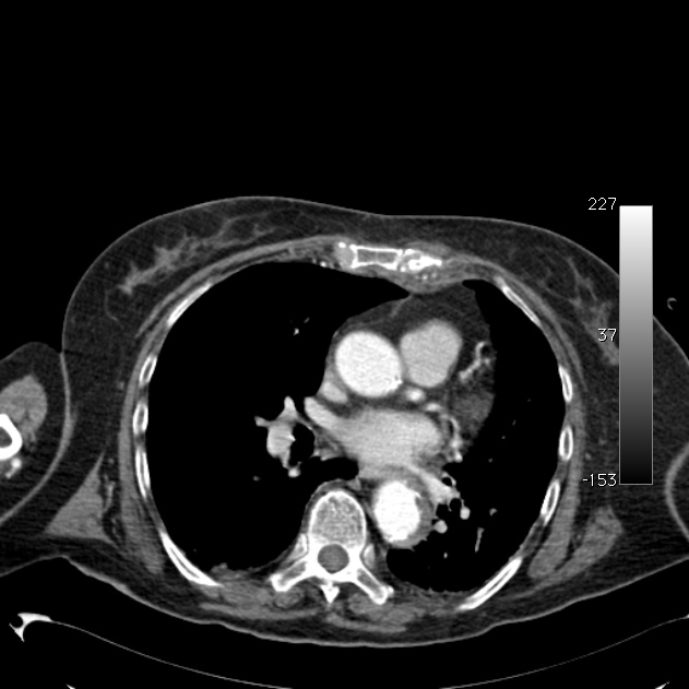 Atypical dissection of the thoracic aorta (Radiopaedia 10975-11393 A 40).jpg