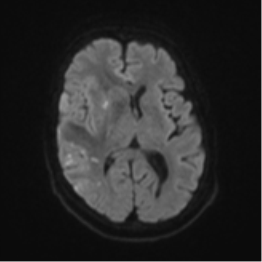 Atypical meningioma (WHO Grade II) (Radiopaedia 54742-60979 Axial DWI 43).png