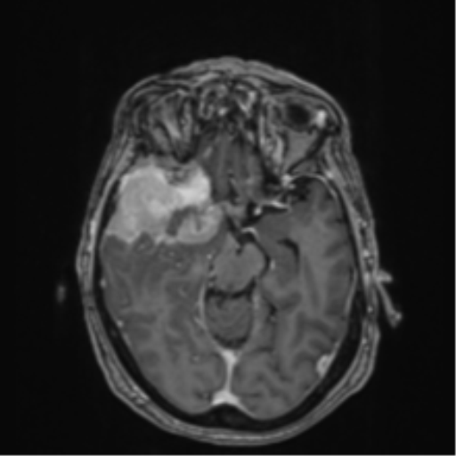 Atypical meningioma (WHO Grade II) (Radiopaedia 54742-60979 Axial T1 C+ 24).png