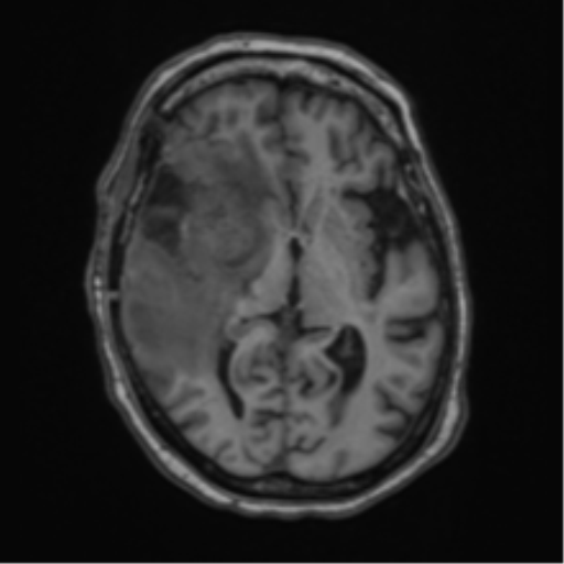 Atypical meningioma (WHO Grade II) (Radiopaedia 54742-60981 Axial T1 34).png