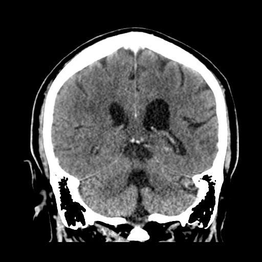 File:Atypical meningioma (WHO grade II) with brain invasion (Radiopaedia 57767-64728 Coronal C+ 41).png